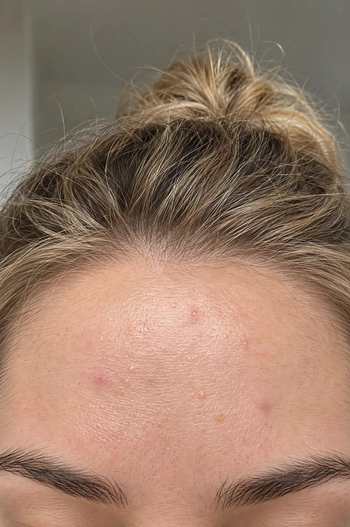 Close-up of a forehead with visible blemishes